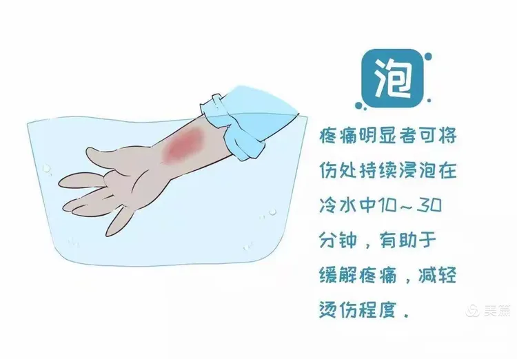 儿童烫伤居家处理